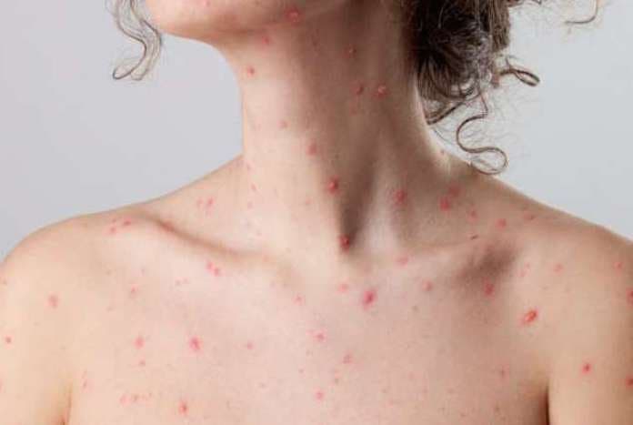 Bệnh thủy đậu lây qua những đường nào?