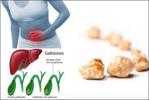 Sỏi túi mật: Khi nào cần phẫu thuật?