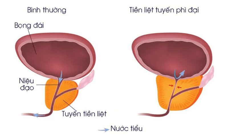 Bệnh tăng sinh lành tính tuyến tiền liệt (u xơ tuyến tiền liệt): độ tuổi nào mắc bệnh