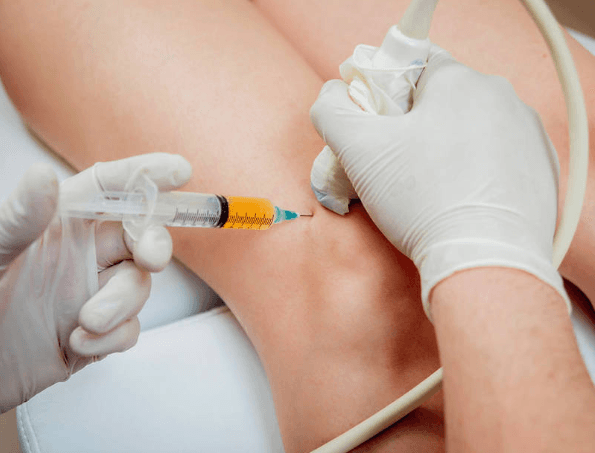 Điều trị rách sụn chêm bằng huyết tương giàu tiểu cầu (PRP)