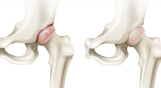 Các biện pháp điều trị hoại tử (tiêu) chỏm xương đùi nặng