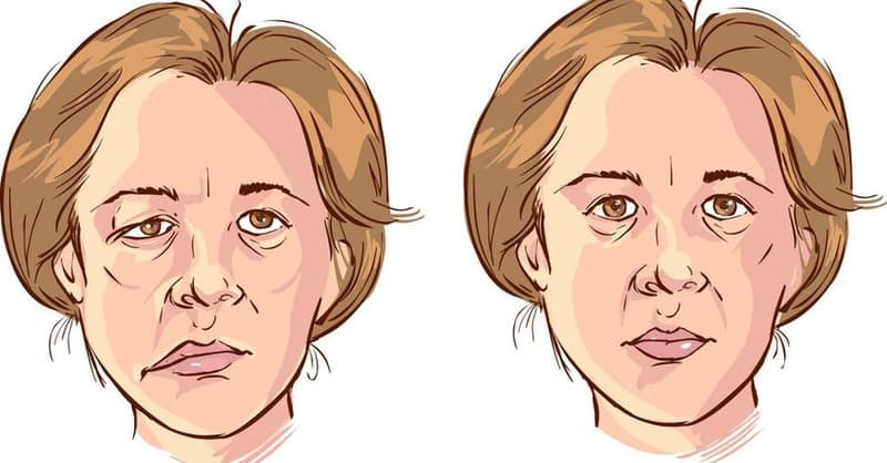 Liệt dây thần kinh số VII (liệt mặt) có nguy hiểm không?