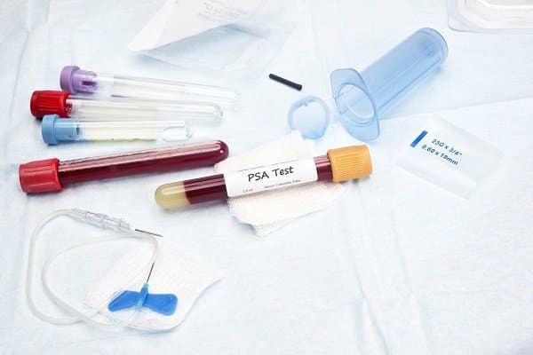 Xét nghiệm nào được dùng để phát hiện ung thư tiền liệt tuyến?