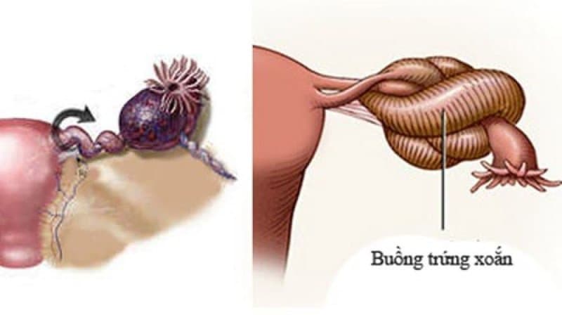 U nang buồng trứng xoắn là bệnh gì, có nguy hiểm không?