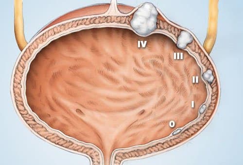 Dấu hiệu và triệu chứng phát hiện sớm ung thư bàng quang ?