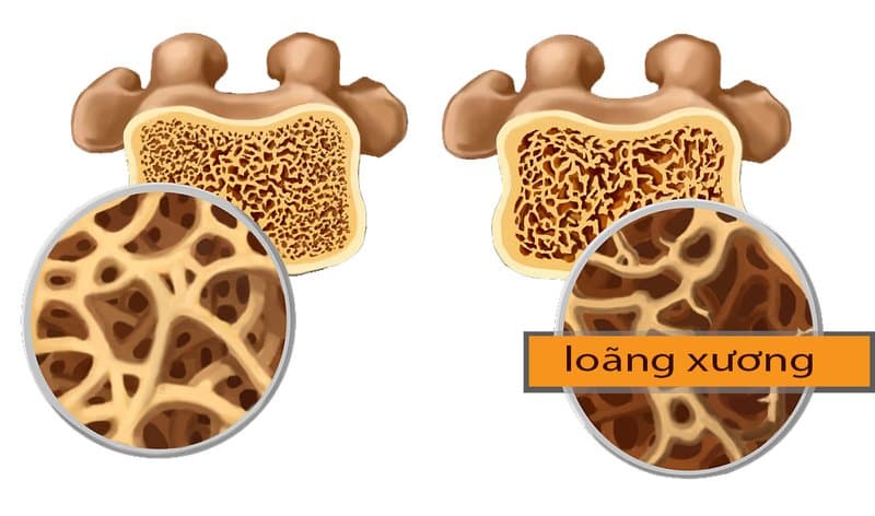 Đo mật độ xương để phát hiện nguy cơ loãng xương