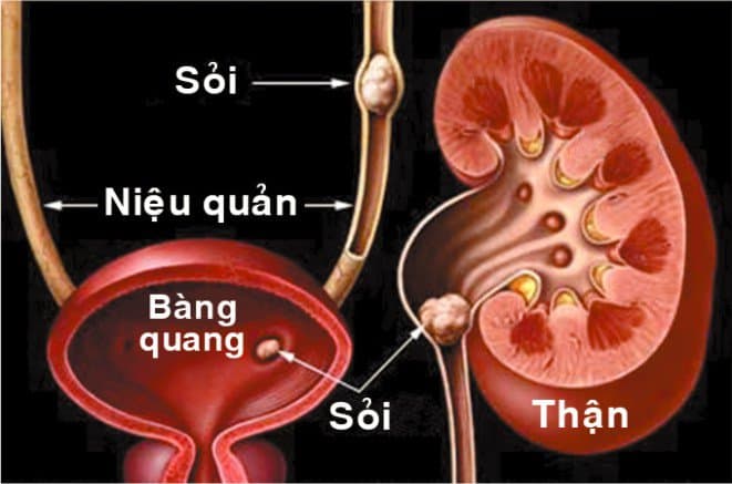 Nội soi tán sỏi ngoài cơ thể (ESWL) phù hợp với bệnh nhân nào? Được thực hiện ra sao?