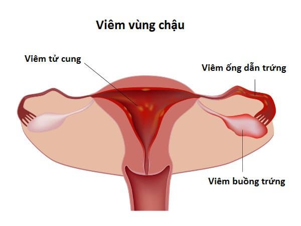 Viêm vùng chậu là bệnh gì? Nguyên nhân, triệu chứng và cách phòng ngừa