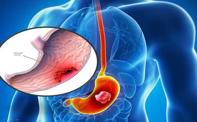 Hiệu quả của hóa trị trong điều trị ung thư dạ dày