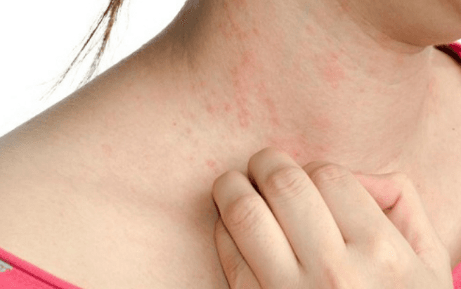 Bị sốt xuất huyết có ngứa không?