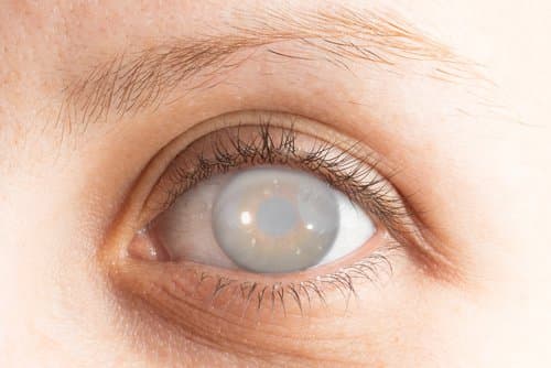 Bệnh đục thủy tinh thể có thể gây mù lòa - Cần phát hiện sớm để điều trị