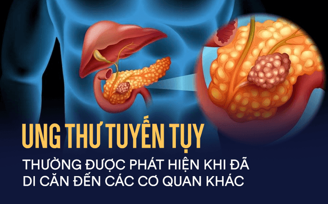 Uung thư tụy Những điều cần biết