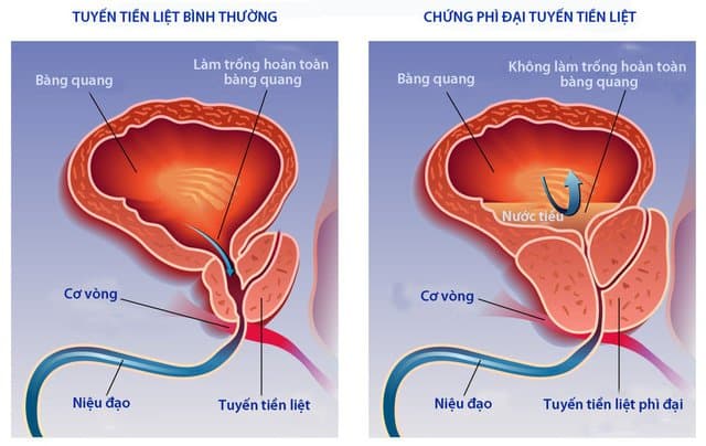 Phì đại tiền liệt tuyến: Khi nào cần mổ?