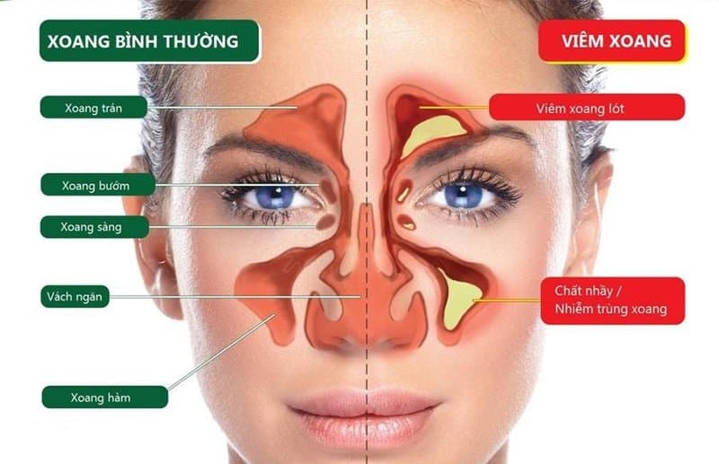 Cách chăm sóc người bị bệnh viêm xoang cấp