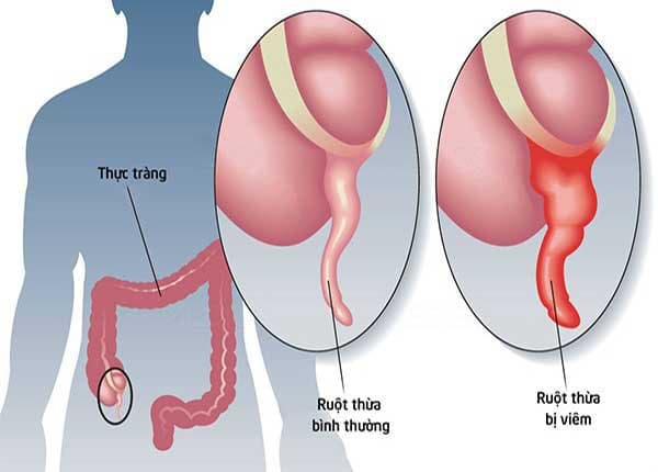 Biến chứng nguy hiểm của viêm ruột thừa cấp