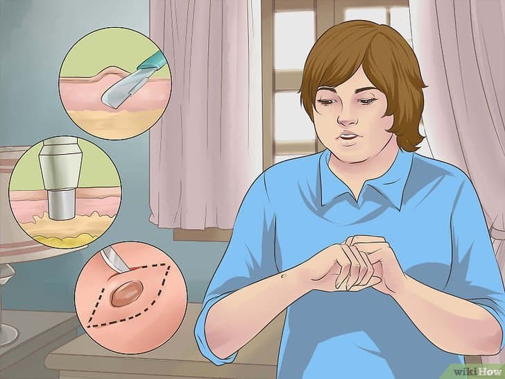 Sinh thiết da trong chẩn đoán ung thư da