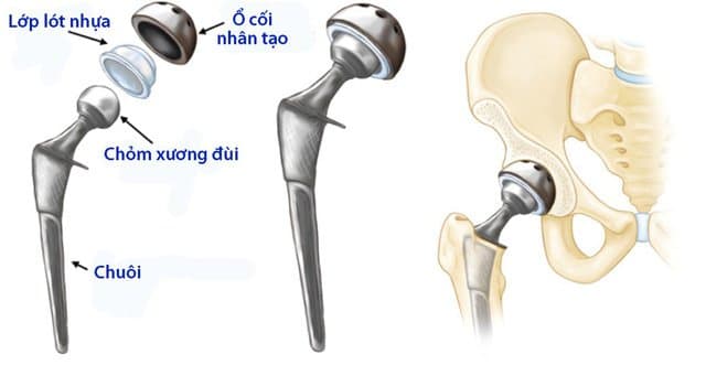 Biến chứng có thể gặp sau thay khớp háng nhân tạo