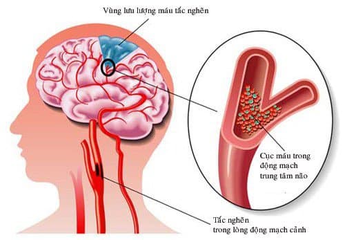 Thuốc tiêu sợi huyết Điều trị nhồi máu não