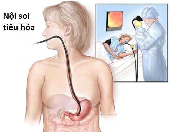 Nội soi tầm soát sau mổ ung thư đại trực tràng, tránh tái phát