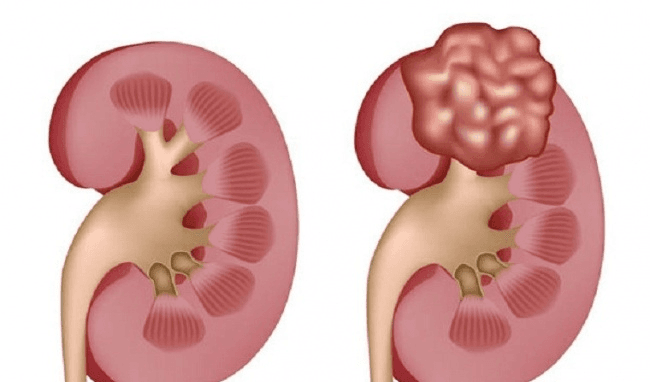 Phân biệt thận đa nang và nang thận