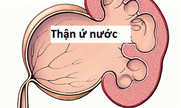 Thận ứ nước là bệnh gì?, Dấu hiệu, nguyên nhân và cách phòng ngừa