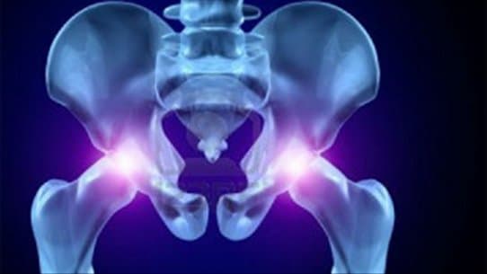 Thay lại khớp háng nhân tạo - Những điều cần biết