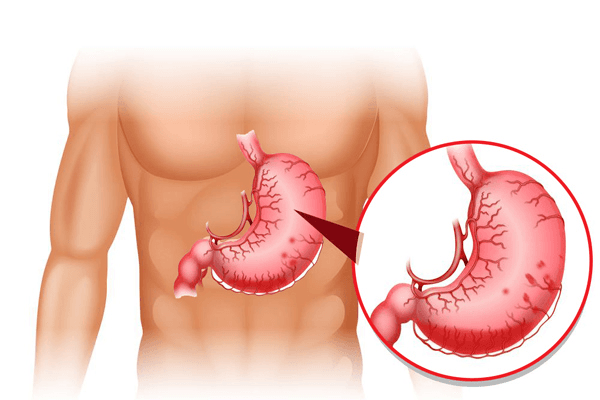 Hẹp môn vị: Biến chứng thường gặp ở bệnh loét dạ dày tá tràng mãn tính