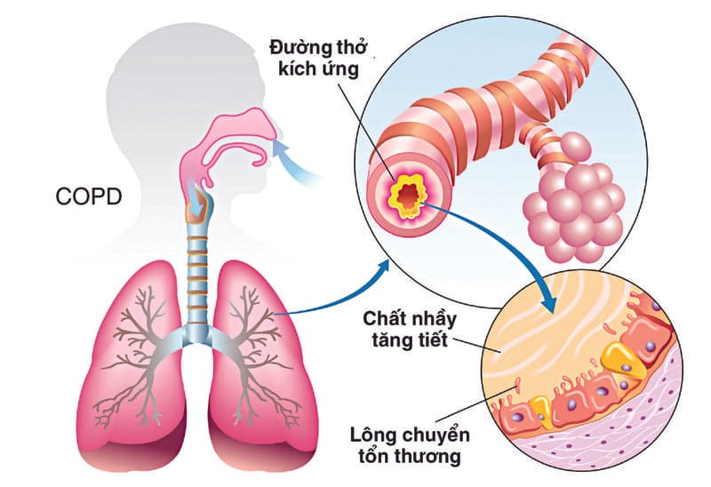 Bệnh phổi tắc nghẽn mãn tính có phải là hen suyễn do hút thuốc lá?