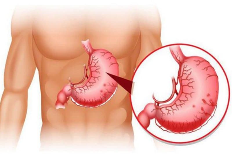 Xuất huyết tiêu hóa nhiều lần - Nguyên nhân, cách điều trị