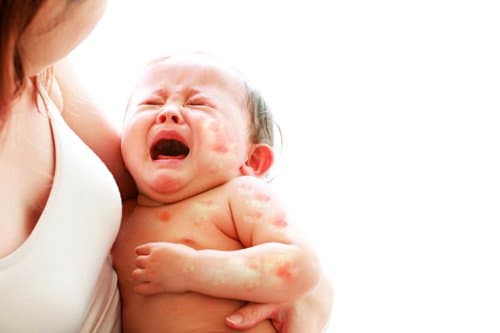 Trẻ bị dị ứng sữa là gì? - Nguyên nhân, dấu hiệu nhận biết và cách xử lý