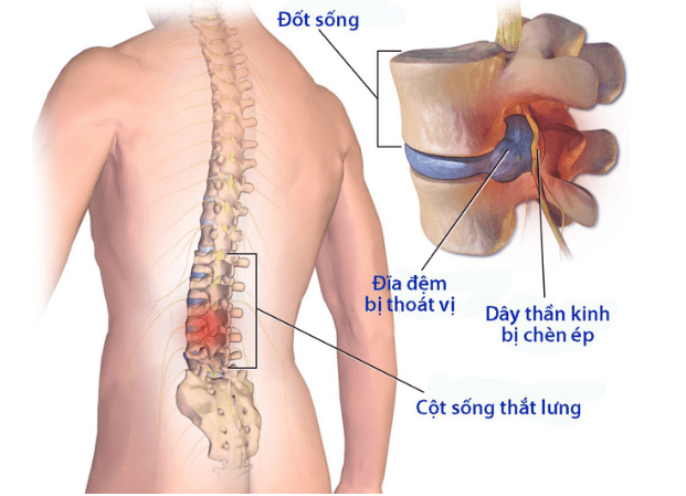Đốt sống thắt lưng: Đặc điểm, chức năng và Các bệnh thường gặp