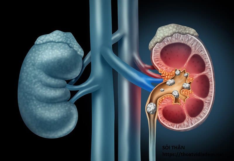 Bị sỏi thận đau ở đâu?, có đau nhiều không?