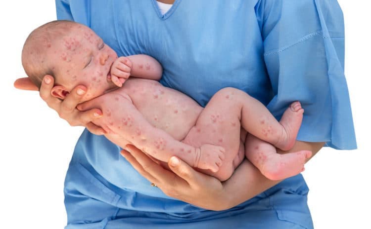 Cách phòng ngừa Hội chứng rubella bẩm sinh
