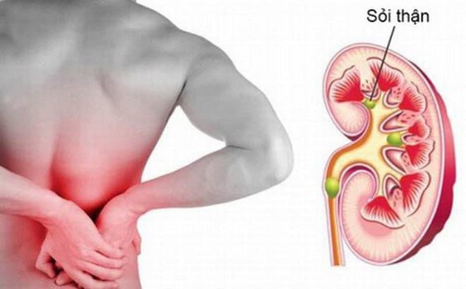 Các phương pháp điều trị sỏi thận