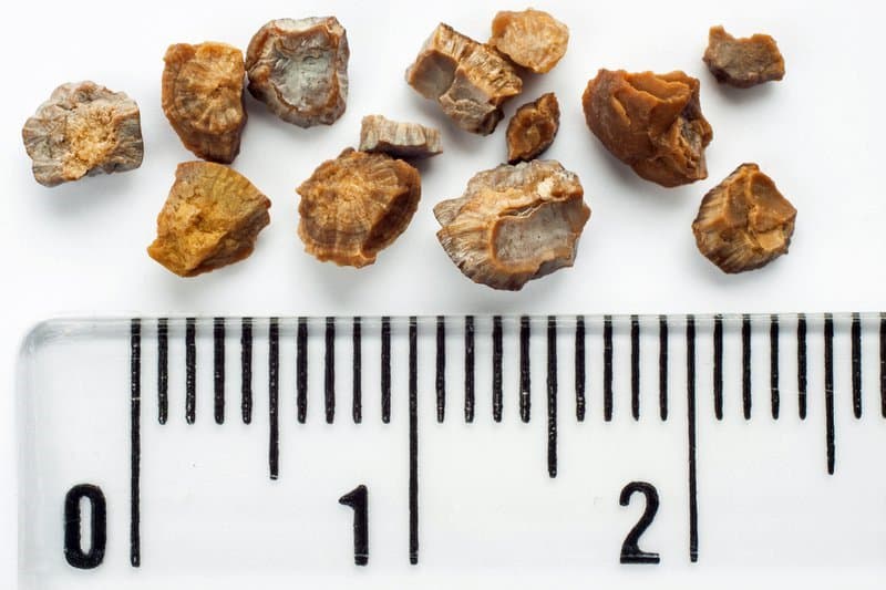 Sỏi thận 6-7mm có nguy hiểm không? nên uống thuốc hay nên phẫu thuật?