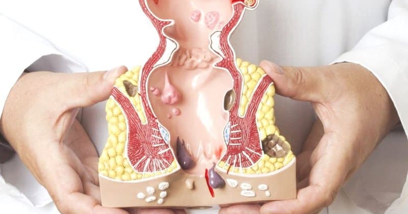 Bệnh trĩ là bệnh gì? Triệu chứng và Cách điều trị