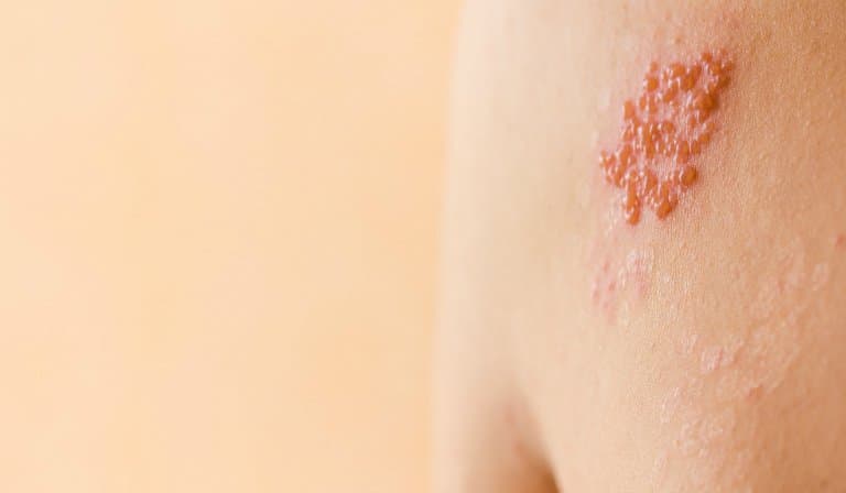Giời leo là bệnh gì? và Cách chữa giời leo ở môi, miệng, cổ không để lại sẹo
