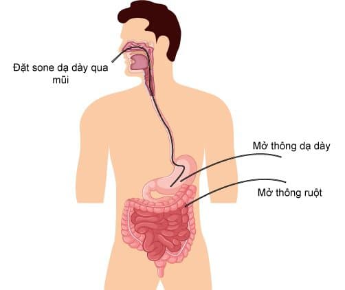 Mở thông dạ dày nuôi dưỡng bệnh nhân ung thư thực quản