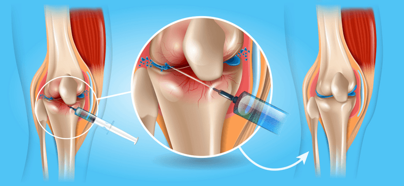 Khi nào có thể tiêm chất nhờn chữa thoái hóa khớp gối?