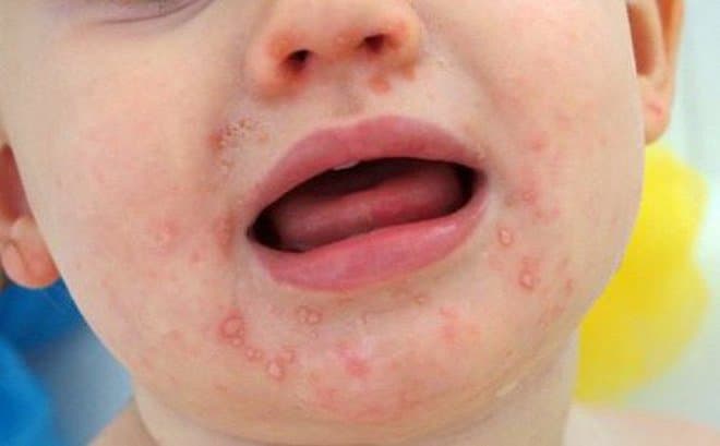 Biến chứng thần kinh ở bệnh nhi mắc tay chân miệng