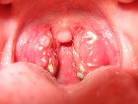 Viêm amidan hốc mủ là bệnh gì? Nguyên nhân, dấu hiệu nhận biết và Cách điều trị
