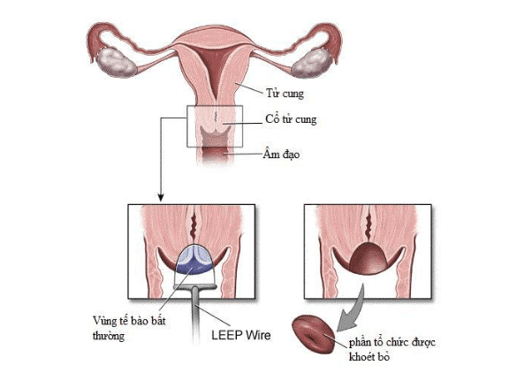 Các nguy cơ có thể gặp sau khoét chóp cổ tử cung