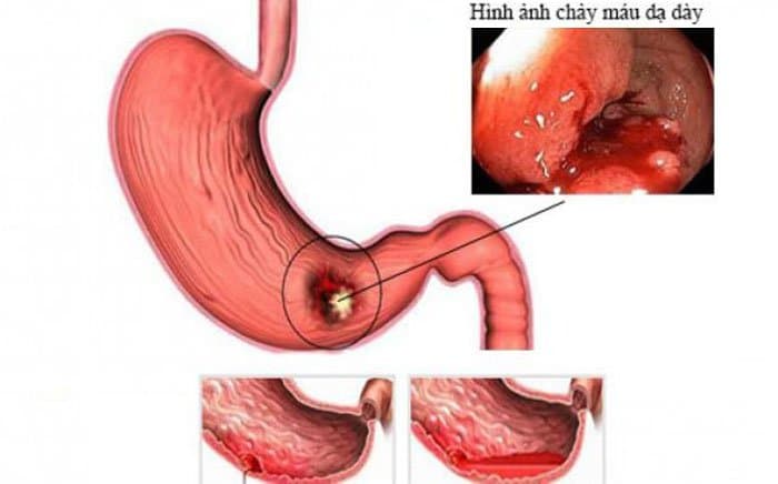 Kỹ thuật xạ hình chẩn đoán chảy máu dạ dày, ruột (xuất huyết đường tiêu hóa) ở trẻ em