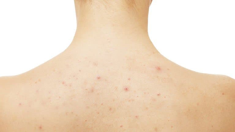 Vì sao viêm nang lông kéo dài dai dẳng, dễ tái phát?