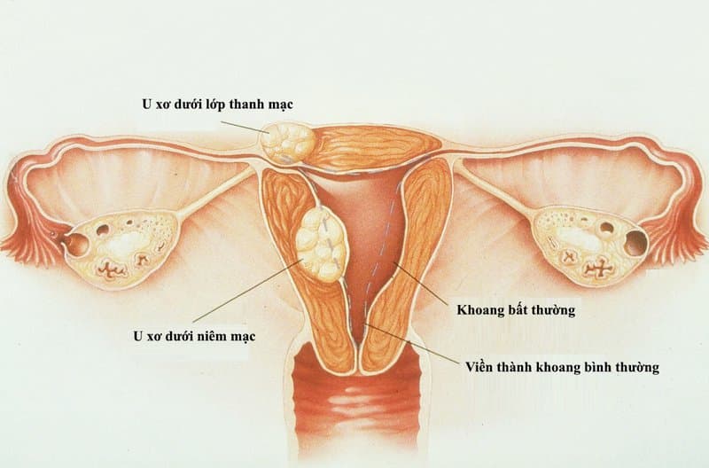 U xơ tử cung khi mang thai có nguy hiểm?