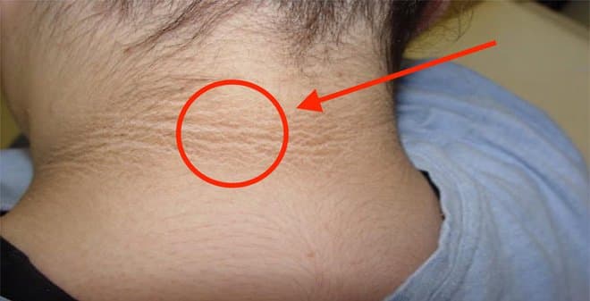 Bệnh gai đen (acanthosis nigricans) có nguy hiểm không?