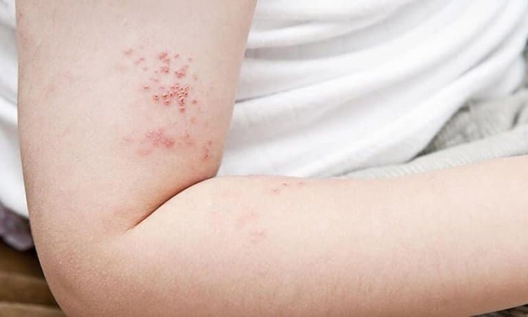 Zona ở trẻ em: Những điều cần biết