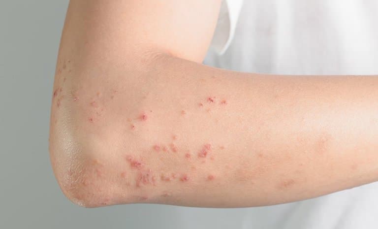 U hạt dị ứng và viêm mạch: Những điều cần biết