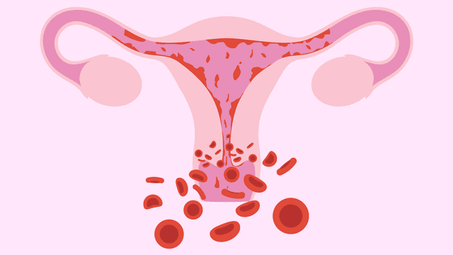 Polyp cổ tử cung có tự rụng?