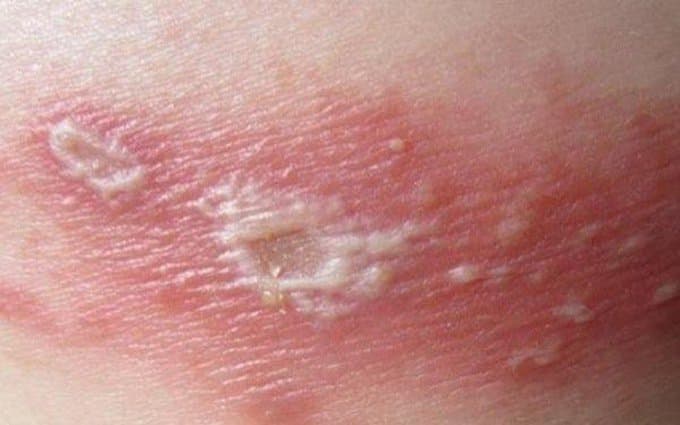 Bệnh zona thần kinh lây như thế nào?